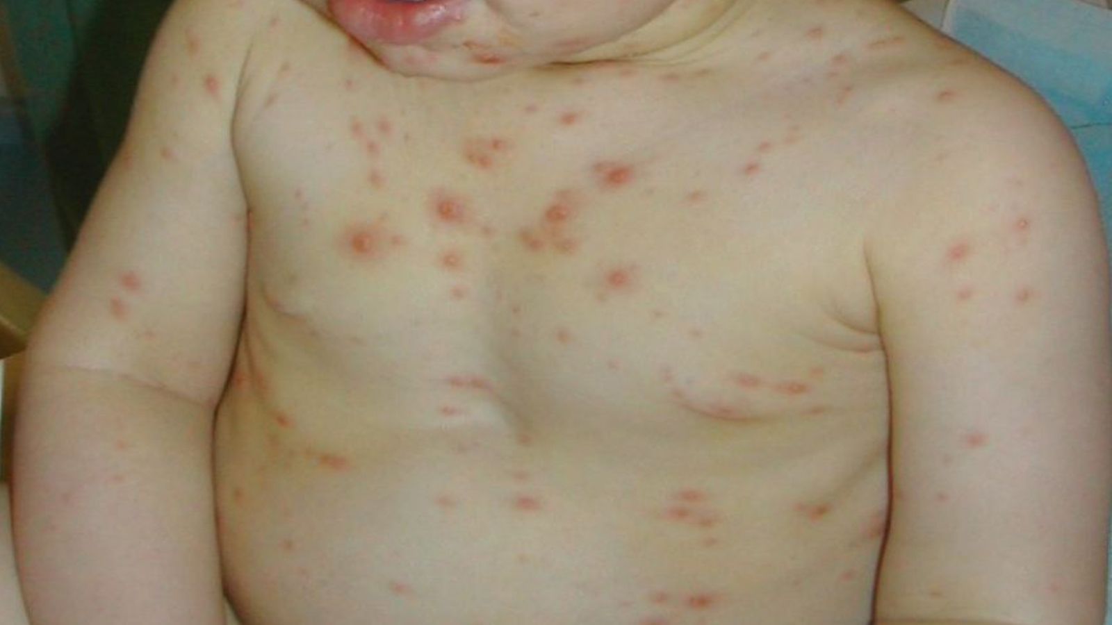 Chickenpox