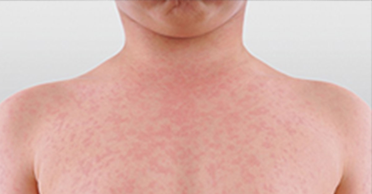 Measles Alert For Brisbane